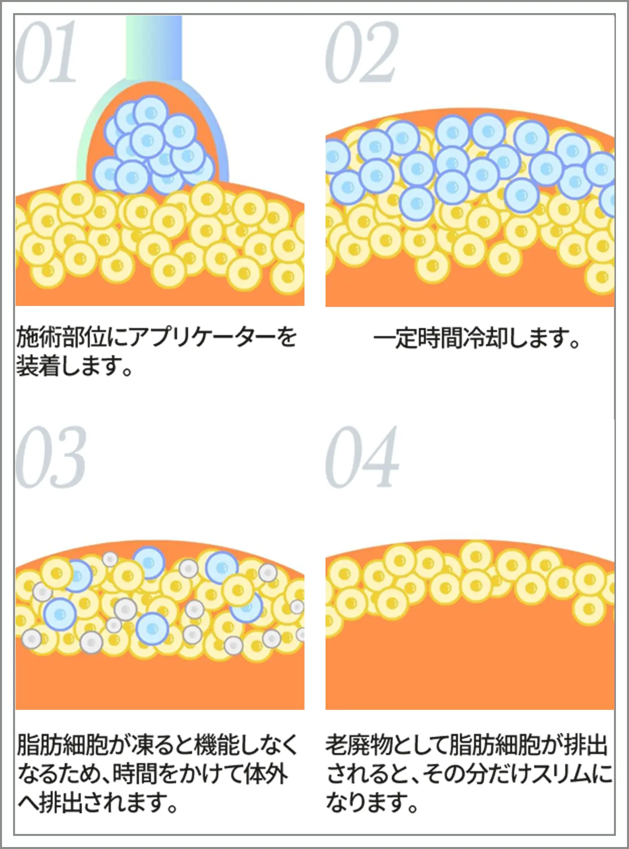 脂肪細胞だけを狙って凍らせる図解