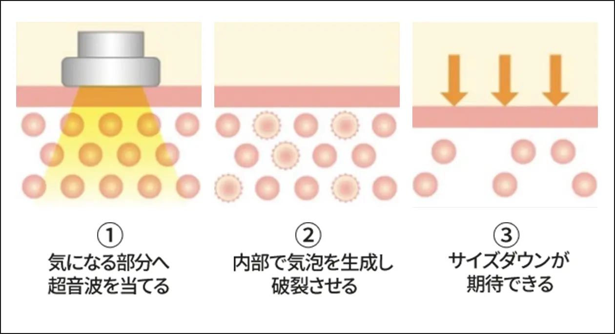 超音波振動による刺激図解